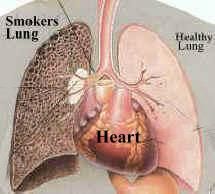 Smokers Lung